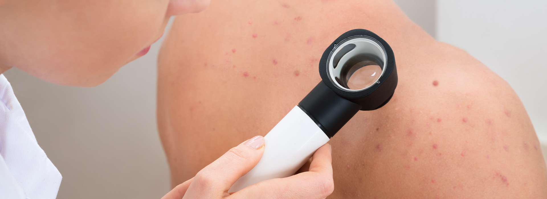Prevenzione Melanoma